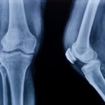 Lag Screws In Epiphyseal