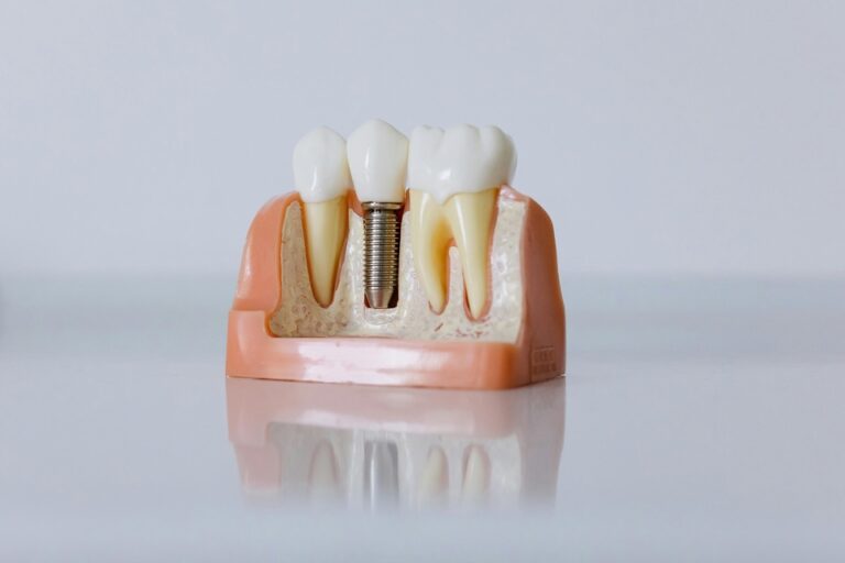 Dental Implants