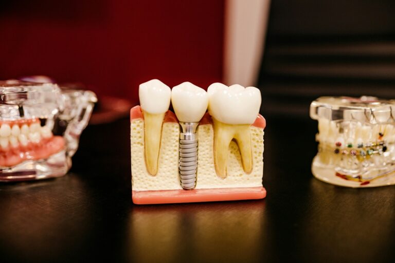 What You Need To Know About Modern Dental Implants