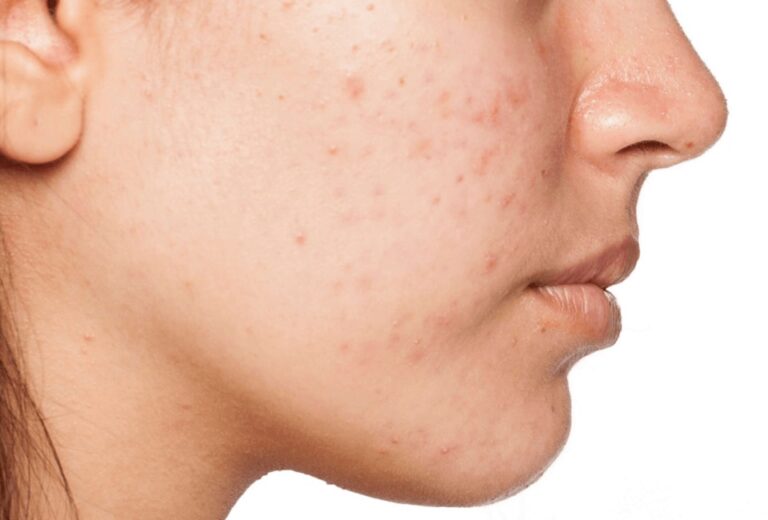Which Acne Scarring Treatment Gives The Fastest Results Acne Scarring Treatment