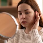 How To Effectively Treat Acne Scars