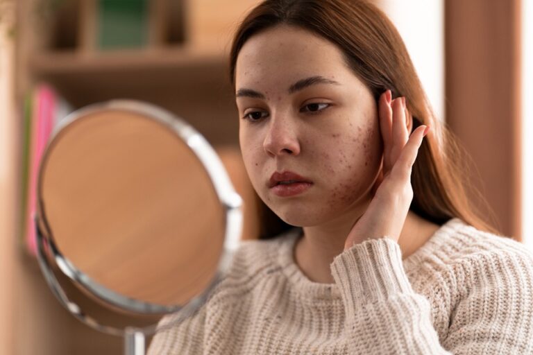 How To Effectively Treat Acne Scars How To Effectively Treat Acne Scars