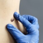 Is Laser Or Surgery Better For Mole Removal