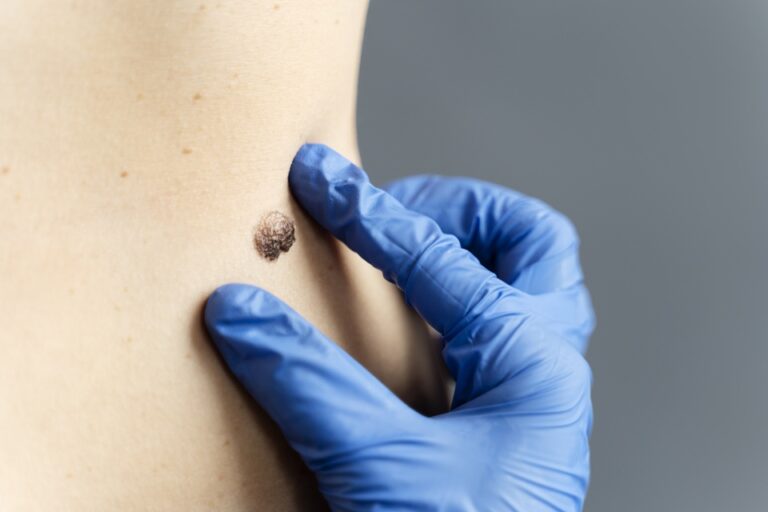 Is Laser Or Surgery Better For Mole Removal Is Laser Or Surgery Better For Mole Removal